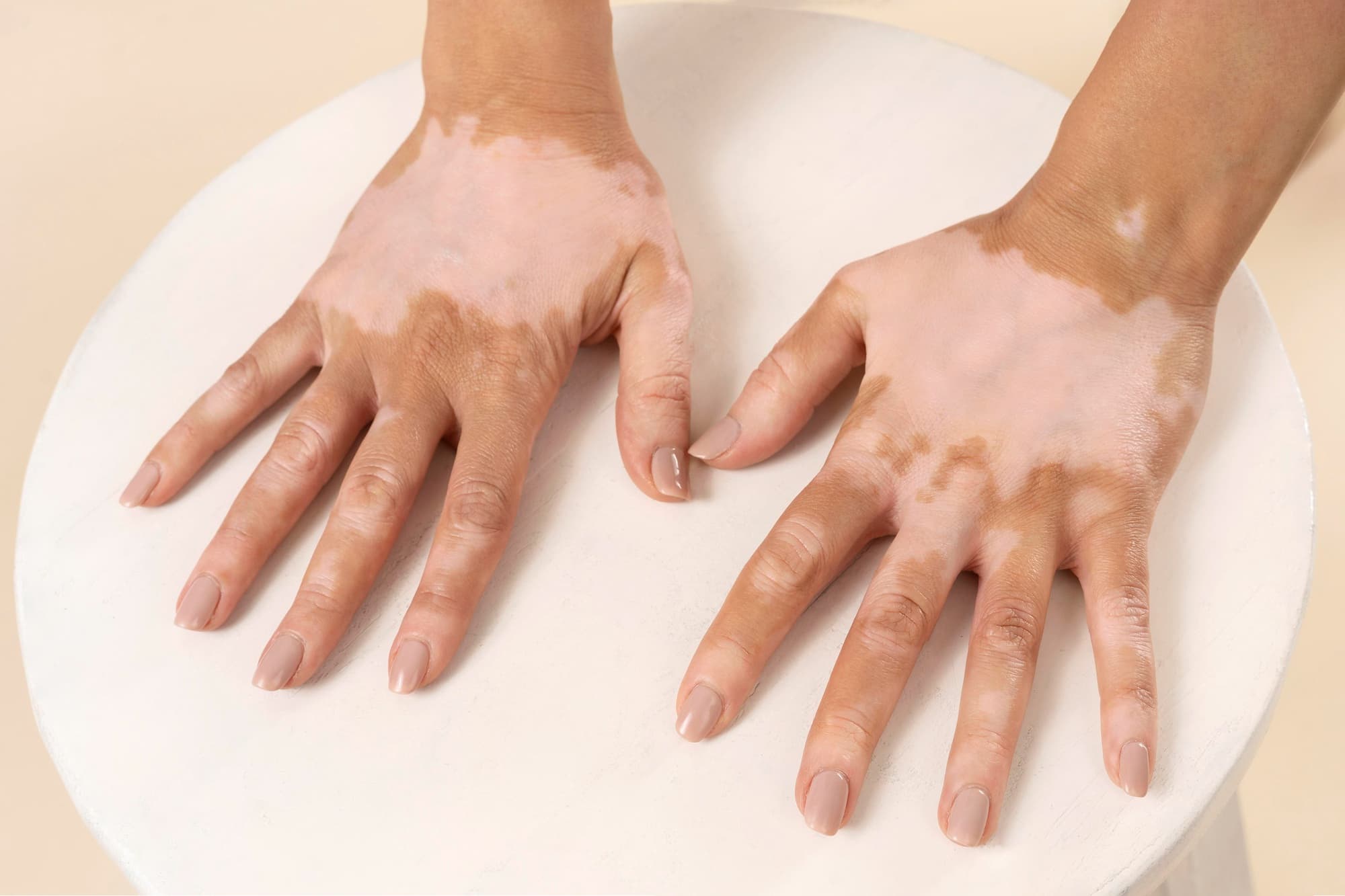 Vitiligo Or White Patch Removal Surgery